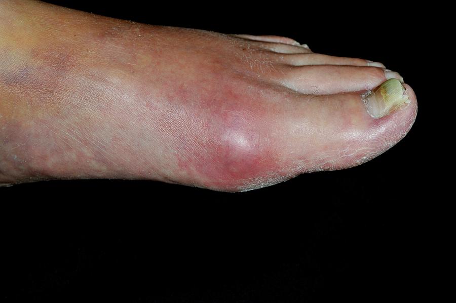 Gout Of The Big Toe Photograph by Dr P. Marazzi/science Photo Library