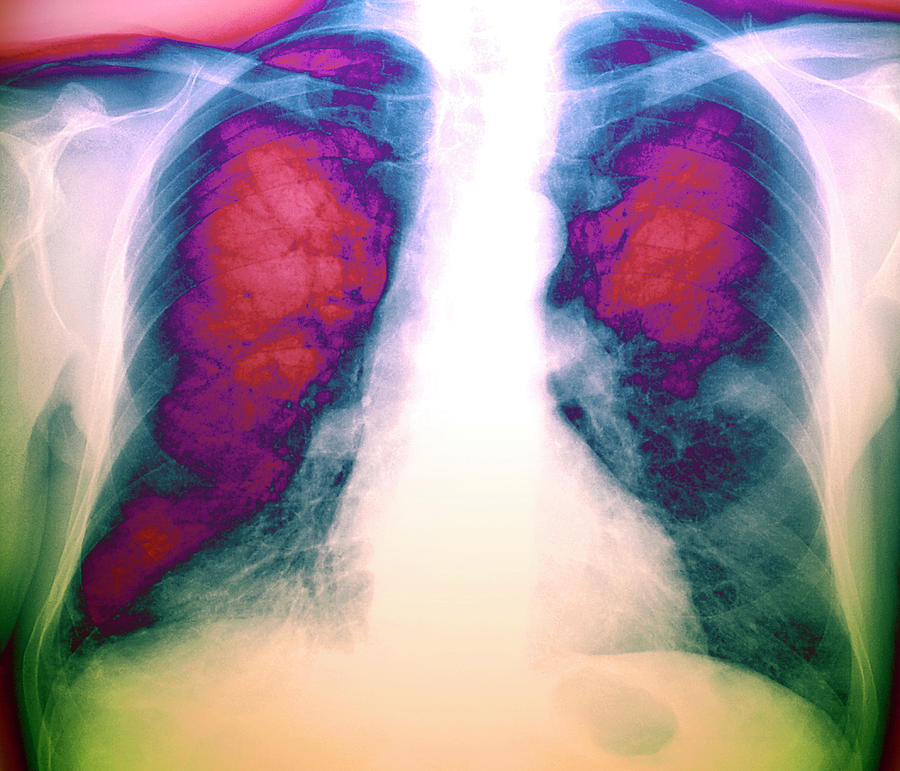 Lung Cancer #9 by Zephyr/science Photo Library