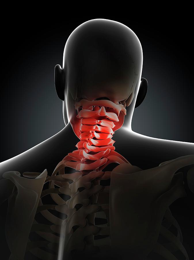 Neck Pain #9 Photograph by Sciepro/science Photo Library