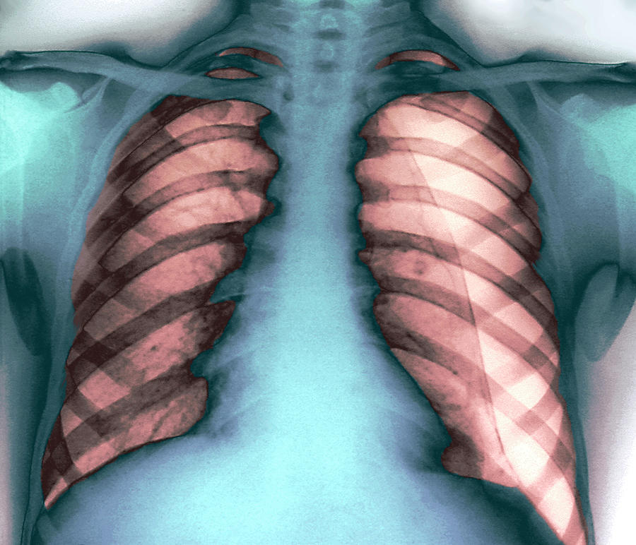 Pneumothorax Photograph By Zephyrscience Photo Library Fine Art America