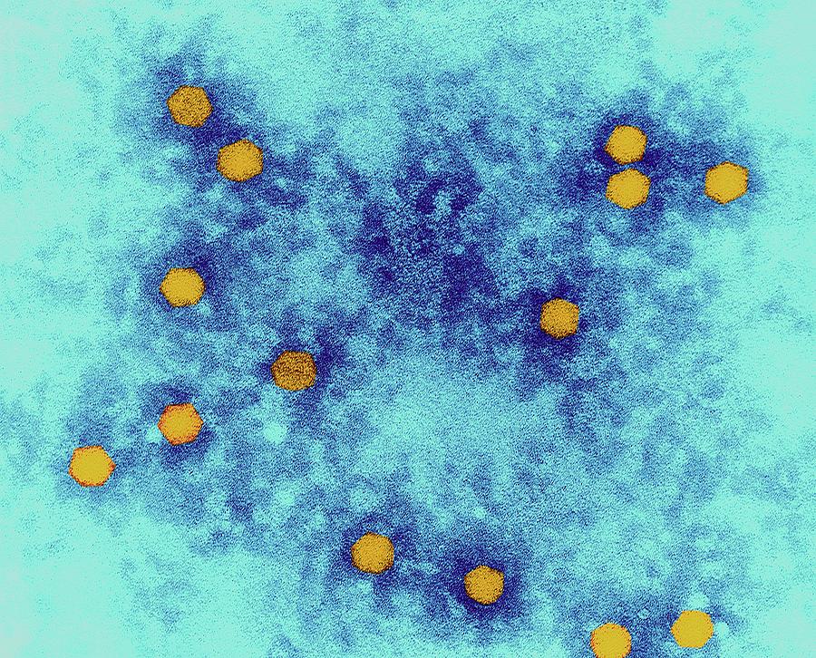 Is Poliomyelitis A Non Curable Viral Disease