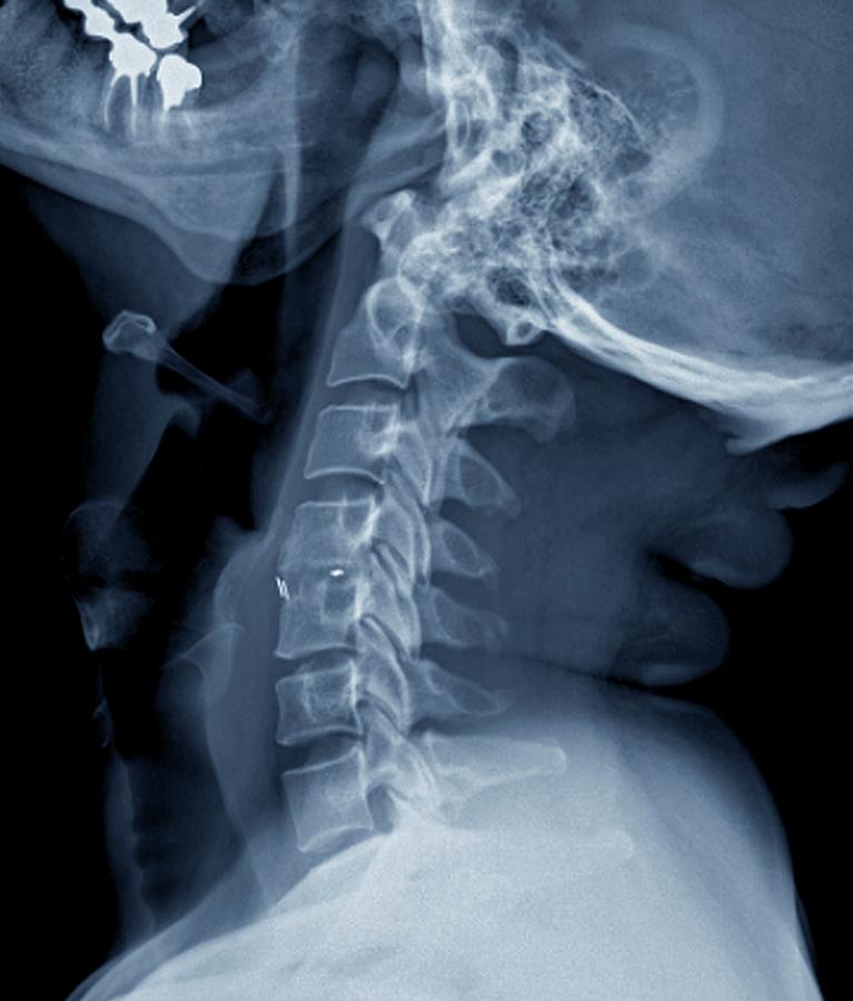 Spine Fixation Photograph by Zephyr/science Photo Library - Pixels