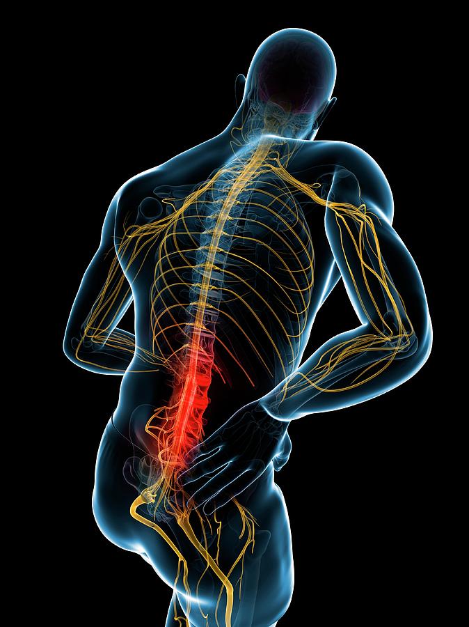 Back Pain #91 Photograph by Sciepro/science Photo Library - Pixels