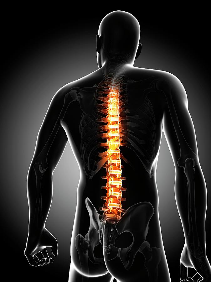 Back Pain Photograph by Sciepro/science Photo Library - Fine Art America