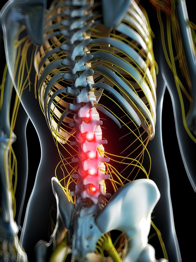 Back Pain #94 Photograph by Sciepro/science Photo Library