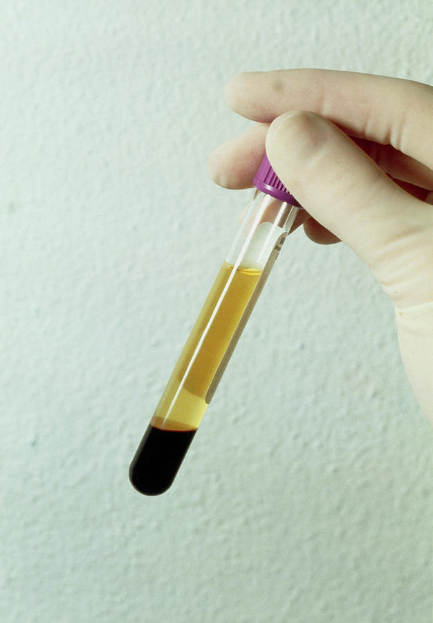 A Centrifuged Blood Sample In A Test Tube Photograph By Klaus