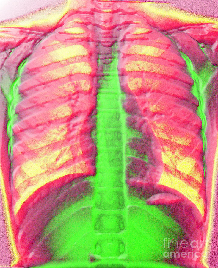 A Normal Chest X-ray Photograph by Scott Camazine