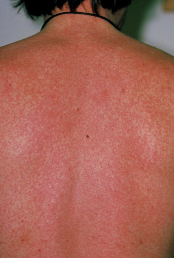 A Severe Measles Rash On The Back Of A Man Photograph by Dr P. Marazzi ...