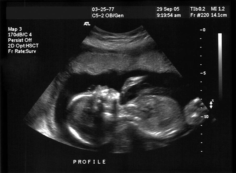 A ultra sound picture of a baby Photograph by Jeffhochstrasser