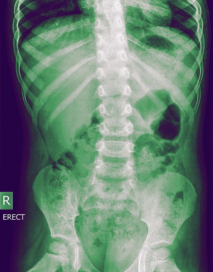 Abdomen X-ray Photograph by Photostock-israel