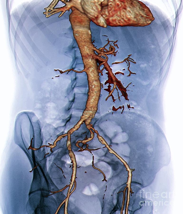 Abdominal Aorta 3d Ct Scan Photograph By Zephyr Fine Art America