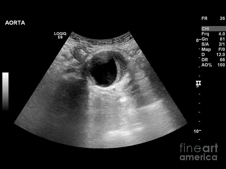 Abdominal Aorta Ultrasound