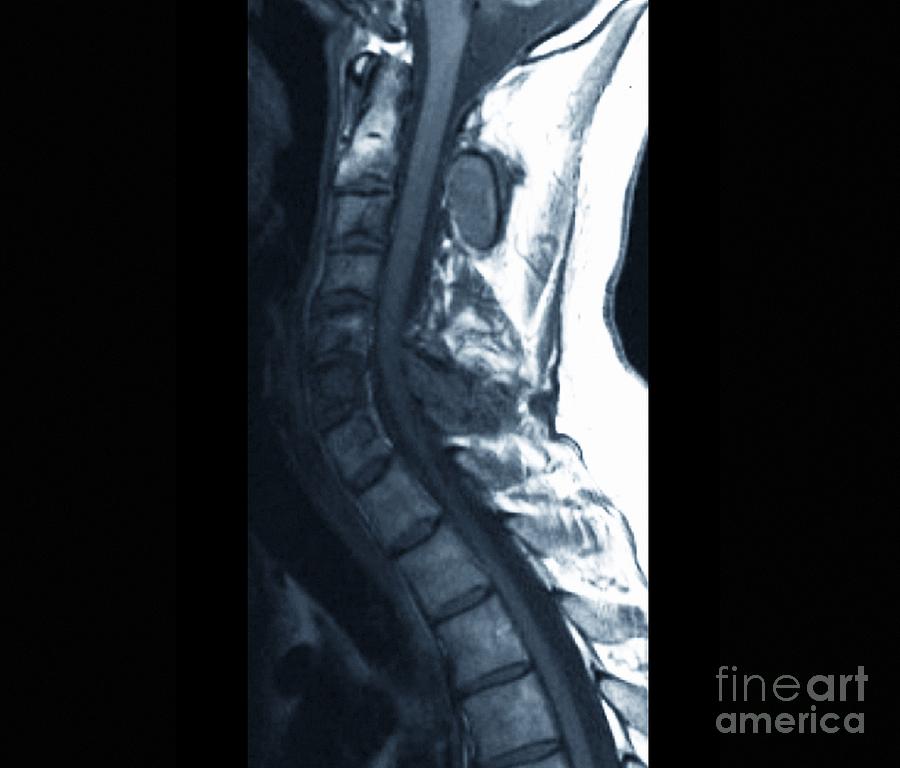 Abnormal Bone Growth, Mri Scan Photograph by Zephyr - Fine Art America