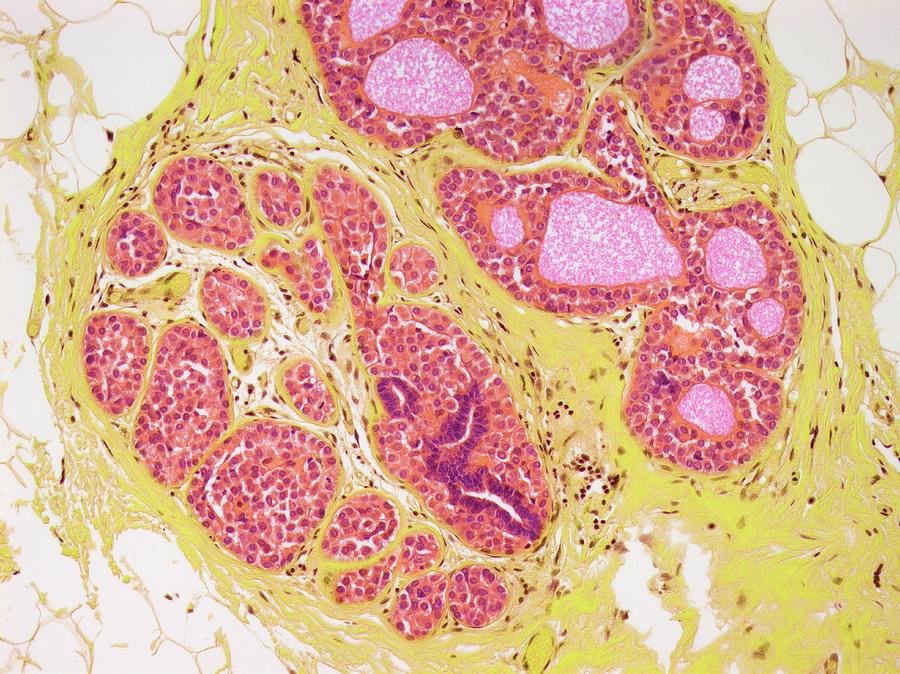 Abnormal Breast Cells Photograph by Steve Gschmeissner