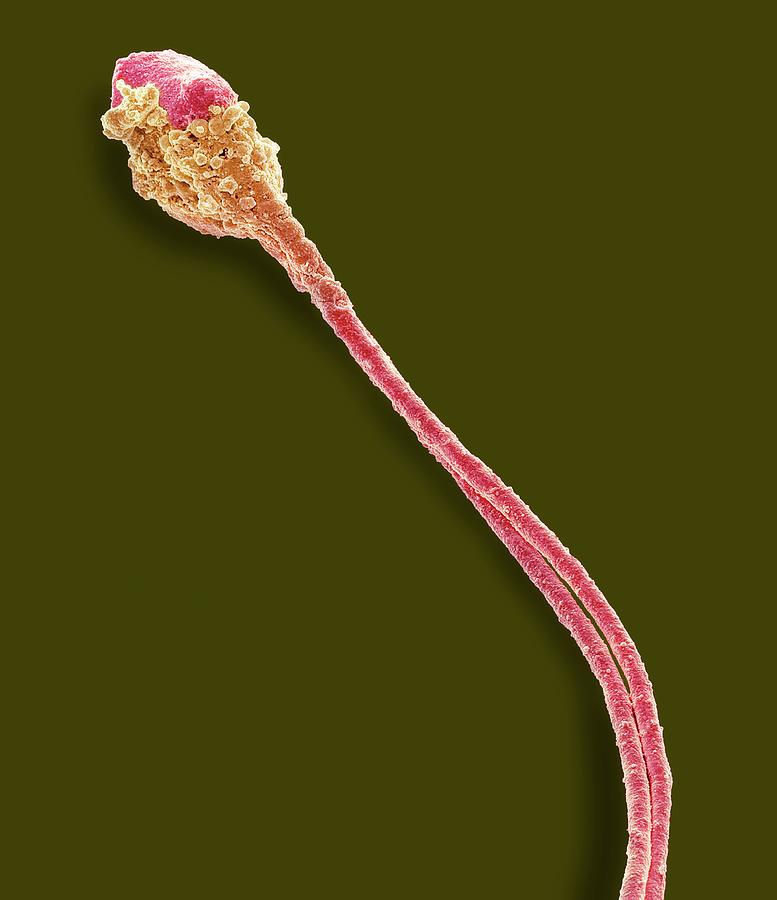 Abnormal Human Sperm Cell Photograph by Steve Gschmeissner