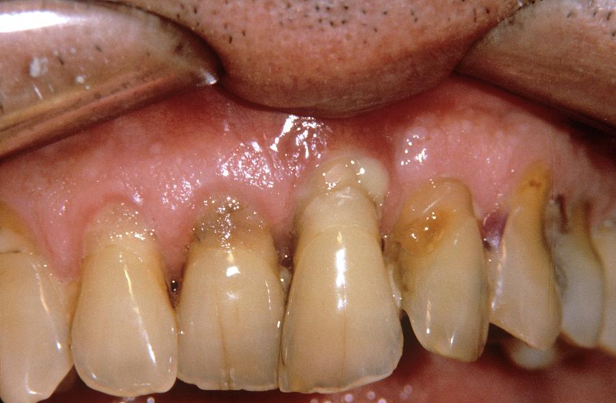 People Photograph - Abscess In Severe Gum Disease by Dr. J.p. Casteyde/cnri