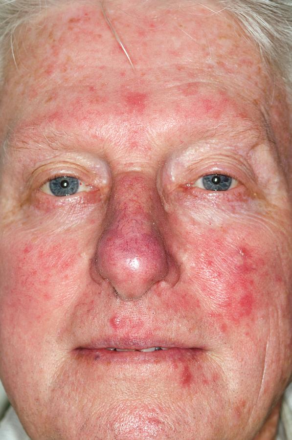 Acne Rosacea On The Face Photograph By Dr P Marazziscience Photo Library 4330