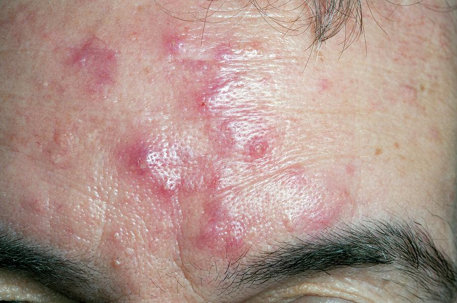 Acne Rosacea On The Forehead Photograph By Dr P Marazzi Science Photo   Acne Rosacea On The Forehead Dr P Marazziscience Photo Library 