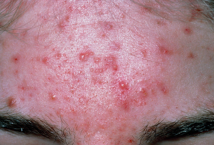 Acne Vulgaris On Forehead Photograph by Dr P. Marazzi/science Photo Library