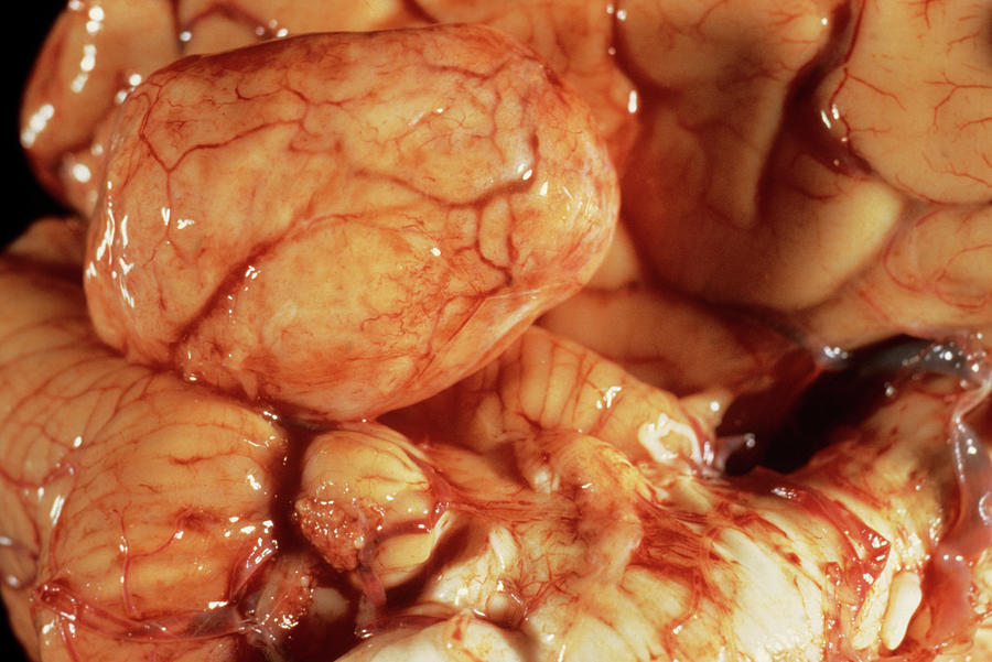Acoustic Neuroma Tumour Photograph by Cnri/science Photo Library