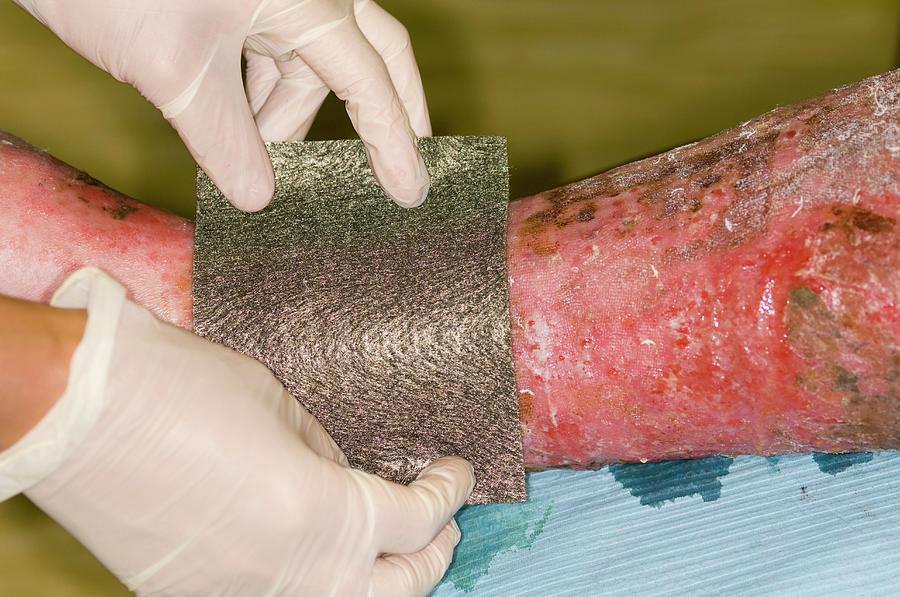 Applied Photograph - Acticoat Treatment Of Varicose Eczema by Dr P. Marazzi/science Photo Library Applied Photograph - Acticoat Treatment Of Varicose Eczema by Dr P. Marazzi/science Photo Library
