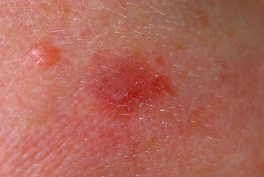 Actinic Solar Keratosis by James Stevenson/science Photo Library