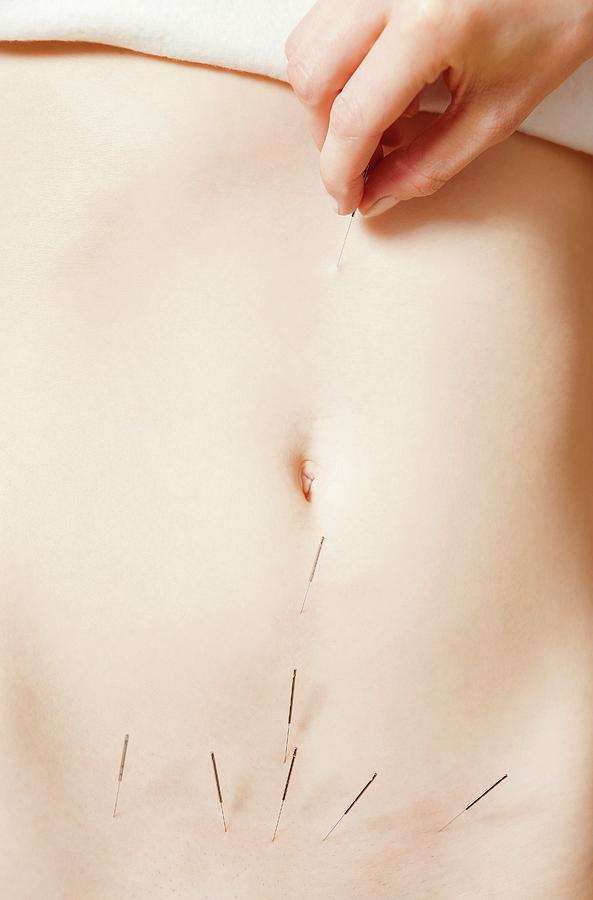 Human Photograph - Acupuncture Fertility Treatment by Thomas Fredberg