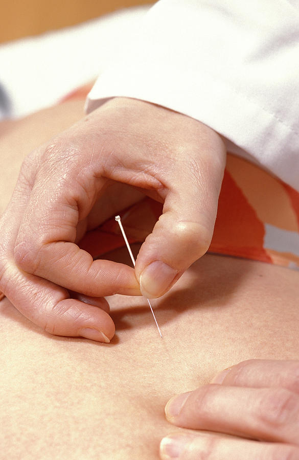 Acupuncture Photograph by Lea Paterson/science Photo Library