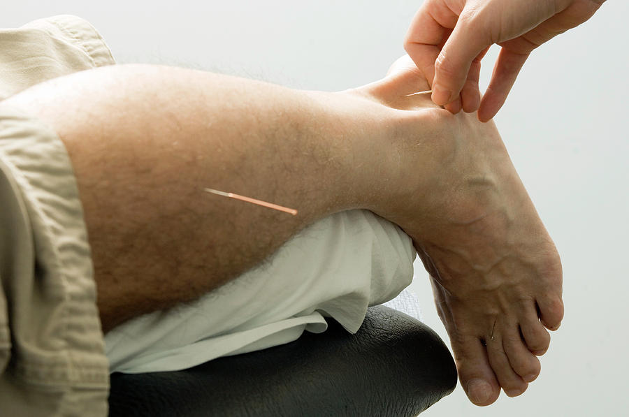 Acupuncture Photograph by Mark Thomas/science Photo Library
