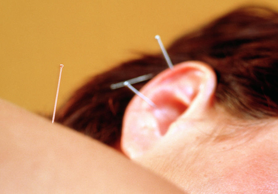 Acupuncture Photograph by Michael Donne/science Photo Library