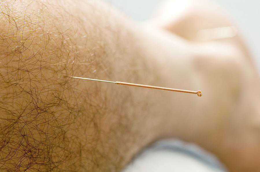 Acupuncture Needle Photograph by Mark Thomas/science Photo Library