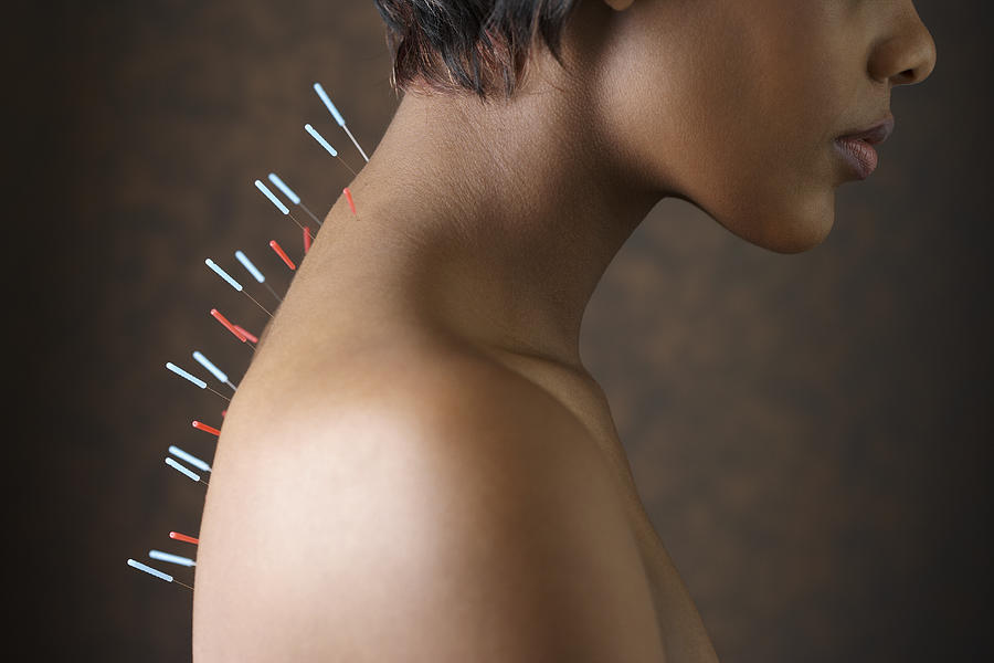 Acupuncture needles in African womans back Photograph by Jon Feingersh Photography Inc