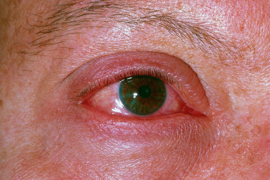 acute-allergic-conjunctivitis-photograph-by-dr-p-marazzi-science-photo