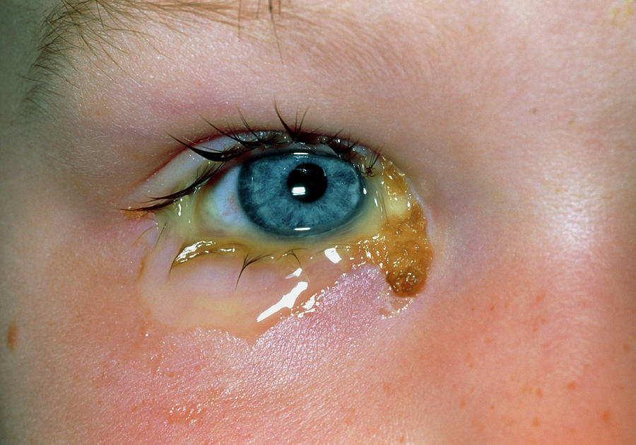 acute-conjunctivitis-discharge-from-child-s-eye-photograph-by-dr-p