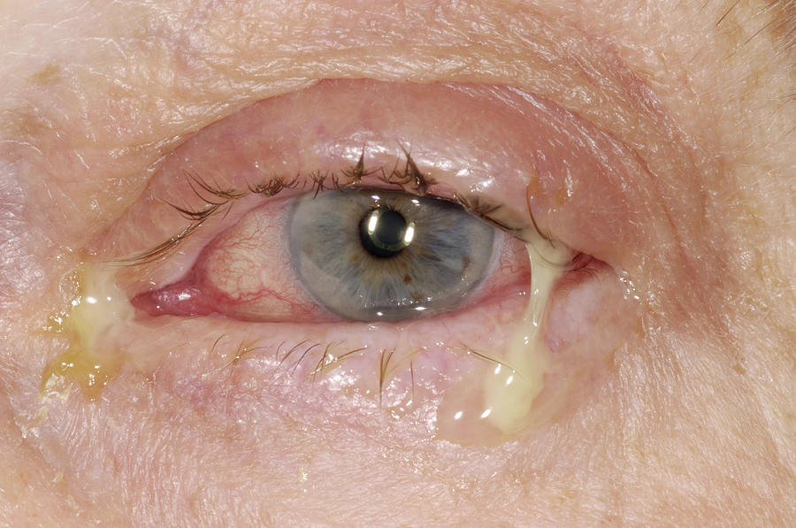 Acute Conjunctivitis Photograph by Dr P. Marazzi/science Photo Library