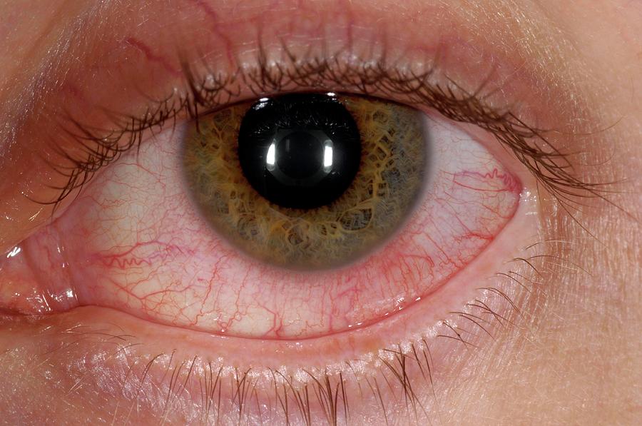 Acute Conjunctivitis Of The Eye Photograph By Dr P Marazziscience
