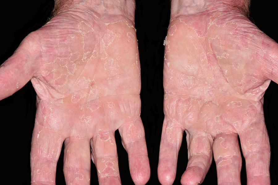 Acute Dermatitis Photograph By Dr P Marazzi Science Photo Library