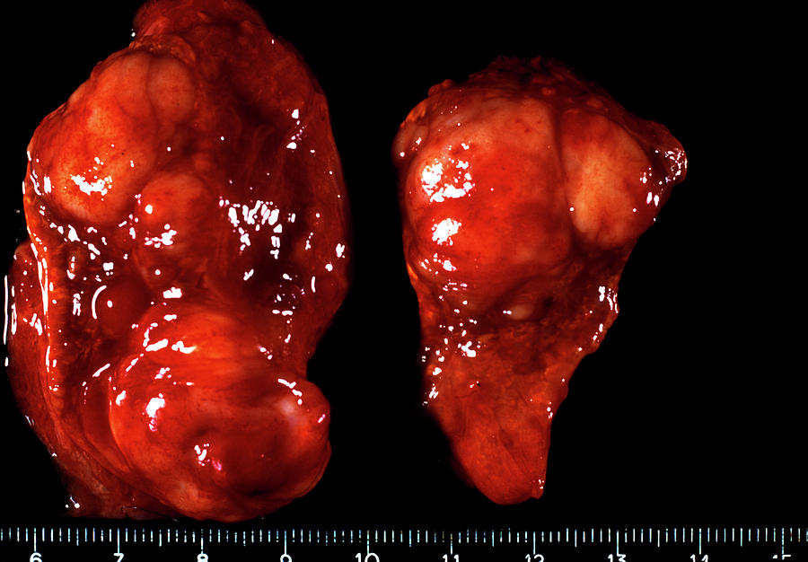 suprarenal gland suprarenal gland