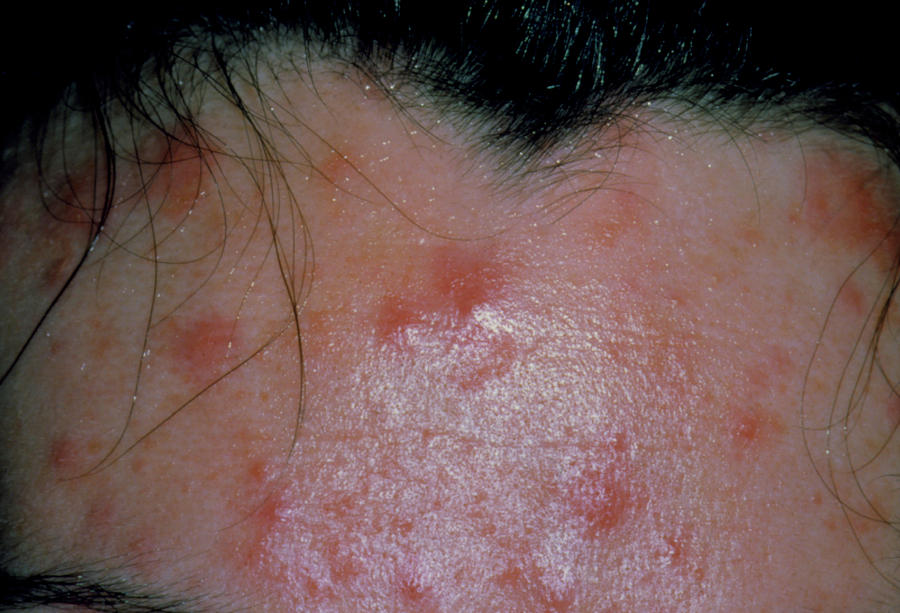 Adult Affected By Chickenpox On The Forehead Photograph By Dr P 