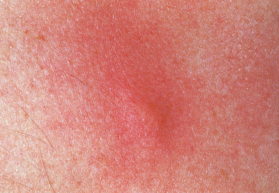 Aggravated Mosquito Bite On A Patients Skin Photograph By Jane Shemilt