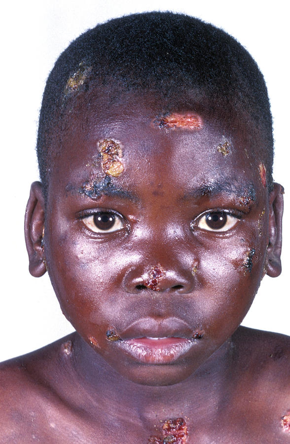 Aids Boy With Impetigo Photograph by Dr M.a. Ansary/science Photo Library