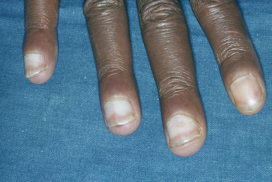 Nail Photograph - Aids Man With Discoloured Fingernails by Dr M.a. Ansary/science Photo Library