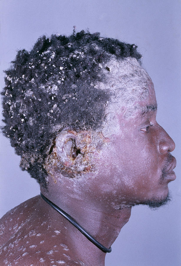 Aids Man With Psoriasis Photograph by Dr M.a. Ansary/science Photo Library