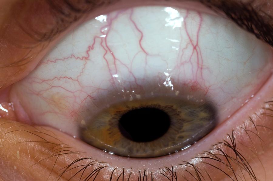 Allergic Conjunctivitis Of The Eye Photograph By Dr P Marazziscience Photo Library 