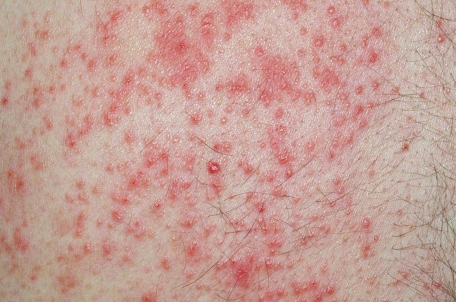 Allergic Dermatitis From Body Armour Photograph By Dr P Marazzi