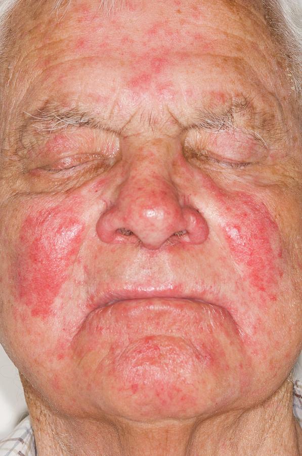 Allergic Skin Reaction To A Drug Photograph by Dr P. Marazzi/science ...