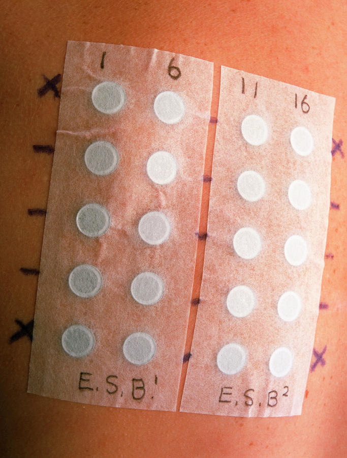 Allergy Test Patches On A Young Woman's Back Photograph by Saturn ...