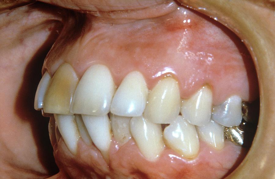 Jaws Photograph - Alveolar Prognathism by Dr. J.p. Casteyde/cnri