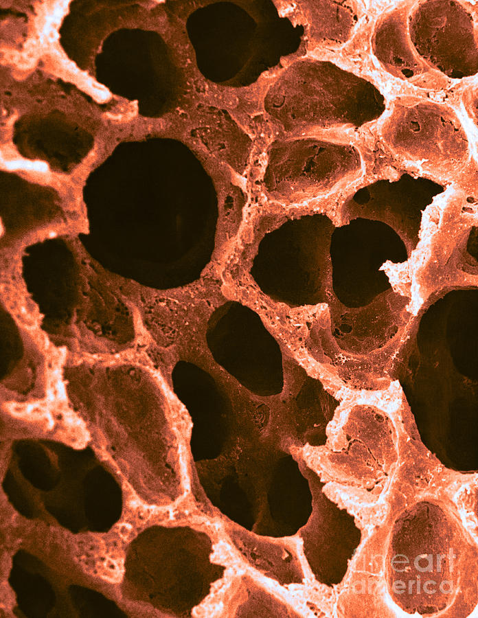 Alveoli In Lung, Sem Photograph by David M. Phillips