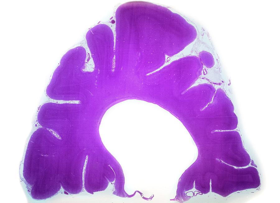 Abnormal Photograph - Alzheimers Brain by Pr. S. Brion/cnri Abnormal Photograph - Alzheimers Brain by Pr. S. Brion/cnri